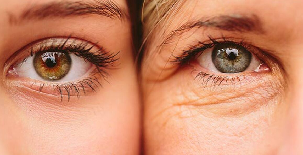 Äußere Alterserscheinungen der Haut um die Augen bei zwei Frauen unterschiedlichen Alters