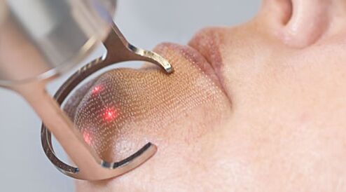 Der Verlauf des Verfahrens zur Verjüngung der Gesichtshaut mit einem fraktionierten Laser