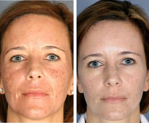 Vor und nach der fraktionierten Gesichtsthermolyse