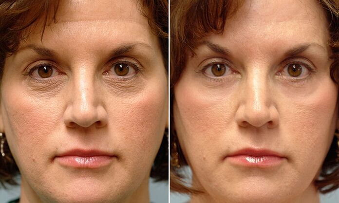 Gesicht vor und nach fraktionierter Laserverjüngung