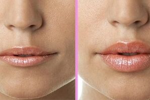 vor und nach der Lippenrestauration
